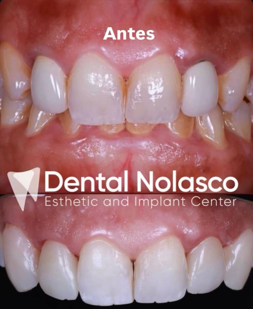 Antes y Después - Caso 6